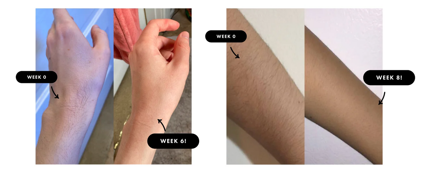 IPL Laser-Haarentferner – 9 Stufen, Ice-Cooling, Unbegrenzte Blitze für Ganzkörper