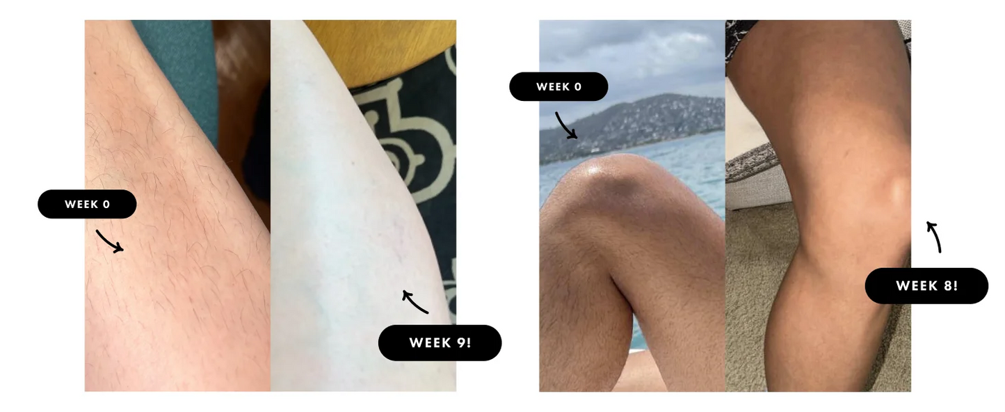IPL Laser-Haarentferner – 9 Stufen, Ice-Cooling, Unbegrenzte Blitze für Ganzkörper