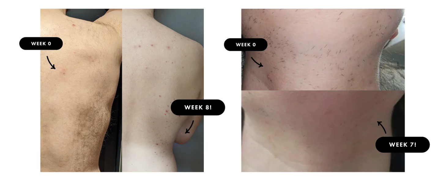 IPL Laser-Haarentferner – 9 Stufen, Ice-Cooling, Unbegrenzte Blitze für Ganzkörper